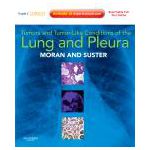 Tumors and Tumor-like Conditions of the Lung and Pleura Expert Consult: Online and Print