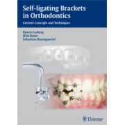Self-ligating Brackets in Orthodontics Current Concepts and Techniques