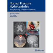 NPH - Normal Pressure Hydrocephalus
Pathophysiology - Diagnosis - Treatment